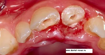 Dental-revue, статті, ортопедична, огляд методів препарування зубів під металокерамічні (коронки на імплантати) Dental-revue, статті, ортопедична, огляд методів препарування зубів під металокерамічні