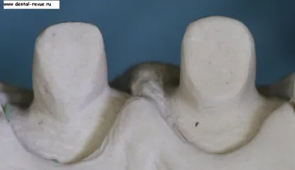 Dental-revue, статті, ортопедична, огляд методів препарування зубів під металокерамічні (стоматологія в москві) Dental-revue, статті, ортопедична, огляд методів препарування зубів під металокерамічні