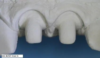 Dental-revue, статті, ортопедична, огляд методів препарування зубів під металокерамічні (виправлення прикусу) Dental-revue, статті, ортопедична, огляд методів препарування зубів під металокерамічні
