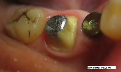 Dental-revue, статті, ортопедична, огляд методів препарування зубів під металокерамічні (металокерамічні коронки) Dental-revue, статті, ортопедична, огляд методів препарування зубів під металокерамічні