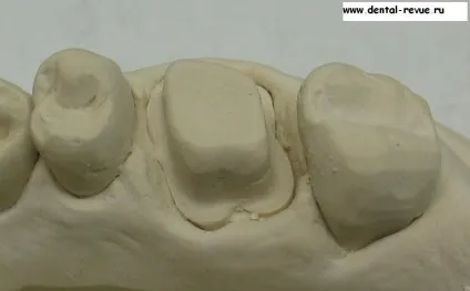 Dental-revue, статті, ортопедична, огляд методів препарування зубів під металокерамічні (протезування зубів) Dental-revue, статті, ортопедична, огляд методів препарування зубів під металокерамічні