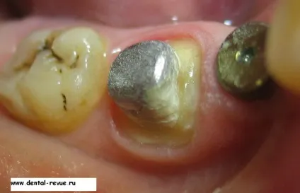 Dental-revue, статті, ортопедична, огляд методів препарування зубів під металокерамічні (препарування) Dental-revue, статті, ортопедична, огляд методів препарування зубів під металокерамічні