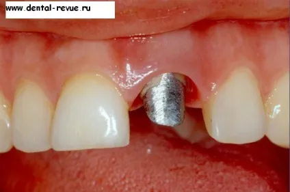 Dental-revue, статті, ортопедична, огляд методів препарування зубів під металокерамічні (препарування) Dental-revue, статті, ортопедична, огляд методів препарування зубів під металокерамічні