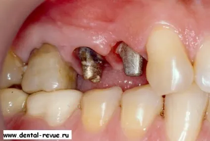 Dental-revue, статті, ортопедична, огляд методів препарування зубів під металокерамічні (ретенційна форма кукси) Dental-revue, статті, ортопедична, огляд методів препарування зубів під металокерамічні