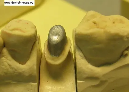 Dental-revue, статті, ортопедична, огляд методів препарування зубів під металокерамічні (стоматологічна клініка) Dental-revue, статті, ортопедична, огляд методів препарування зубів під металокерамічні