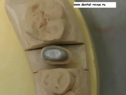 Dental-revue, статті, ортопедична, огляд методів препарування зубів під металокерамічні (безметалова кераміка) Dental-revue, статті, ортопедична, огляд методів препарування зубів під металокерамічні