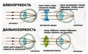 Діоптрії при короткозорості таблиця (діоптрії) Діоптрії при короткозорості таблиця