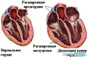 Дилатація серця причини, симптоми, діагностика, лікування лівого і правого шлуночка серця (симптоми) Дилатація серця причини, симптоми, діагностика, лікування лівого і правого шлуночка серця