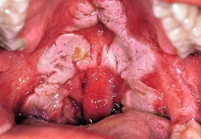 Дифтерія збудник, епідеміологія і патогенез (Corynebacterium diphtheriae gravis) Дифтерія збудник, епідеміологія і патогенез