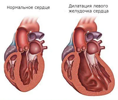 Дилатація передсердь і шлуночків серця лікування і прогноз (серця) Дилатація передсердь і шлуночків серця лікування і прогноз