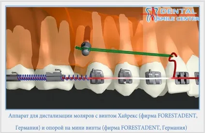 Дісталізація молярів