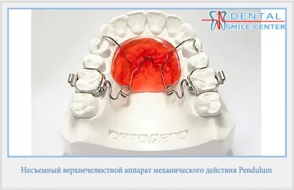 Дісталізація молярів