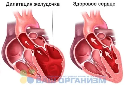 Дилатація серця види, причини і способи лікування (серця) Дилатація серця види, причини і способи лікування
