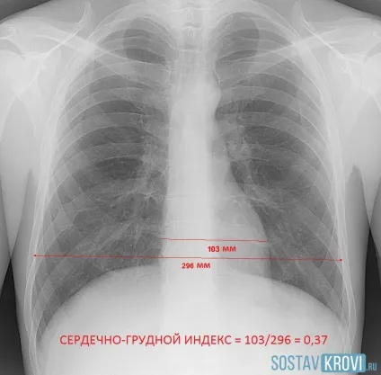 Дилатація серця причини, симптоми, діагностика, лікування лівого і правого шлуночка серця (причини) Дилатація серця причини, симптоми, діагностика, лікування лівого і правого шлуночка серця
