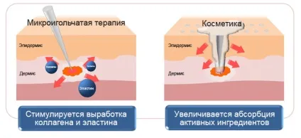 Домашній мезороллер для особи - застосування, відгуки, протипоказання