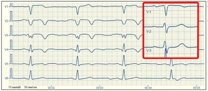 E-cardio рубцеві зміни