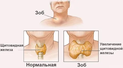 Душить щитовидка що робити, причини (робити) Душить щитовидка що робити, причини