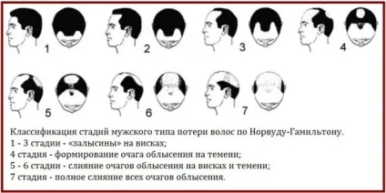 Випадання волосся, облисіння через тестостерону у чоловіків