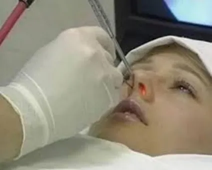 Вавки в носі, ніж лікувати, як попередити появу (лікувати) Вавки в носі, ніж лікувати, як попередити появу