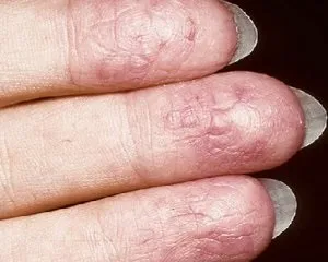 Екзема на руках фото, лікування, початкова стадія, причини (екзема на руках) Екзема на руках фото, лікування, початкова стадія, причини