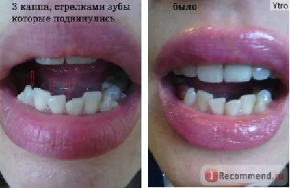 Елайнери - «елайнери (капи) як необхідність і краще сьогодні з існуючих засобів виправлення (змінюються кожні тижні) Елайнери - «елайнери (капи) як необхідність і краще сьогодні з існуючих засобів виправлення