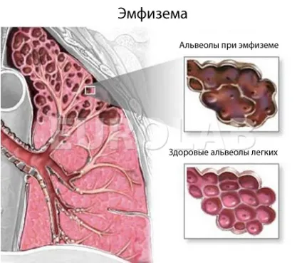 Емфізема легенів симптоми, лікування, прогноз, eurolab, імунологія і алергологія (лікування) Емфізема легенів симптоми, лікування, прогноз, eurolab, імунологія і алергологія