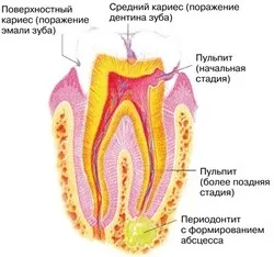 Якщо зуб розболівся ня першої допомоги (хворі зуби пульпіт знеболювання надання першої допомоги) Якщо зуб розболівся ня першої допомоги