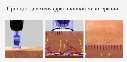 Фракційна мезотерапія особи що це, препарати, що застосовується апарат і ціна та відгуки про процедуру (апарат для фракційної мезотерапії) Фракційна мезотерапія особи що це, препарати, що застосовується апарат і ціна та відгуки про процедуру