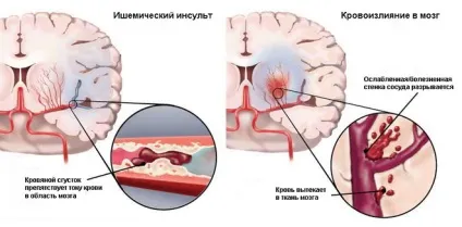 Фізичні навантаження після інсульту як правильно проводити профілактику (навантаження) Фізичні навантаження після інсульту як правильно проводити профілактику