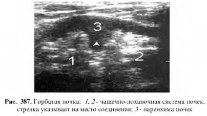 Горбата нирка або пухлина розміри нирки і лікування