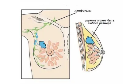 Гормонозалежний рак молочної залози стадії захворювання і прогноз, лікування