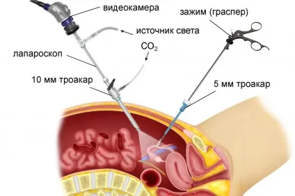 Гінекологічні операції ціни в москві (опущенні стінок піхви) Гінекологічні операції ціни в москві