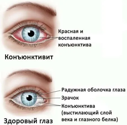 Око опух і гноїться що робити в залежності від причини (опух) Око опух і гноїться що робити в залежності від причини