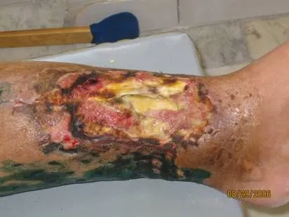 Історія - як я став інвалідом