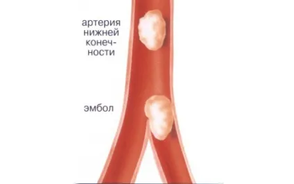 Ішемія нижніх кінцівок - симптоми і лікування (нижніх) Ішемія нижніх кінцівок - симптоми і лікування