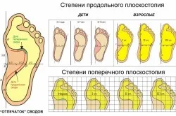 Як бігати з плоскостопістю (плоскостопістю) Як бігати з плоскостопістю