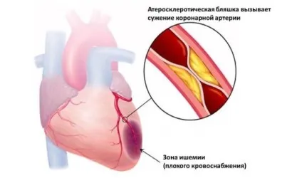 Зміни в міокарді серця - виражені, незначні і рубцеві (міокарді) Зміни в міокарді серця - виражені, незначні і рубцеві