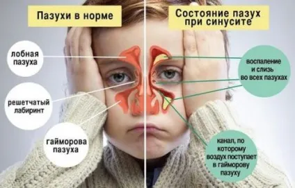 З носа тече жовта рідина що це за слиз, виділення при нахилі