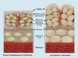 Як боротися з розтяжками, світ без шкоди (розтяжками) Як боротися з розтяжками, світ без шкоди