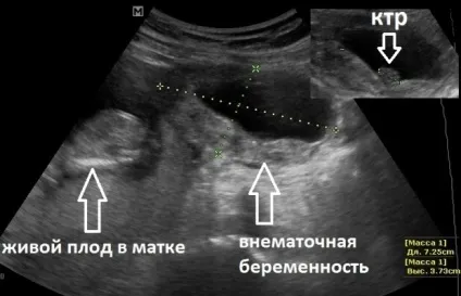 Позаматкова вагітність причини, симптоми, діагностика та лікування (симптоми) Позаматкова вагітність причини, симптоми, діагностика та лікування