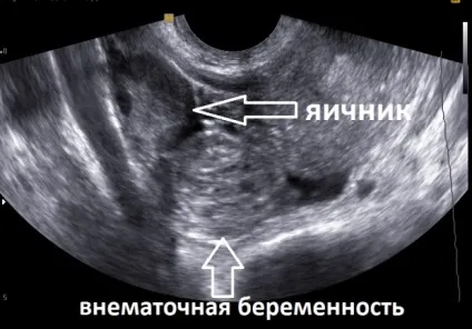 Позаматкова вагітність причини, симптоми, діагностика та лікування (симптоми) Позаматкова вагітність причини, симптоми, діагностика та лікування
