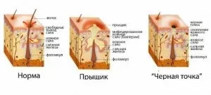Які масла допомагають позбутися від чорних крапок можна робити маски з додаванням масел (олії чорних крапок) Які масла допомагають позбутися від чорних крапок можна робити маски з додаванням масел