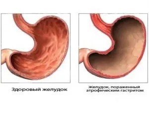 Як лікувати атрофічний гастрит шлунка і його симптоми (гастрит) Як лікувати атрофічний гастрит шлунка і його симптоми