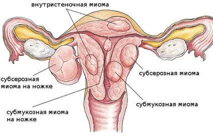 Як лікувати міому матки великих розмірів (матки) Як лікувати міому матки великих розмірів