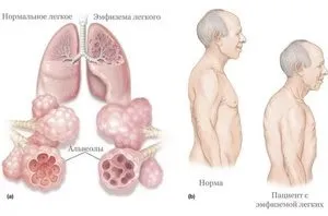 Який прогноз життя дають при емфіземи легенів, симптоми хвороби і методи лікування (емфізема легкий прогноз життя такий симптом лікування це фото підвищений легкість екзема) Який прогноз життя дають при емфіземи легенів, симптоми хвороби і методи лікування
