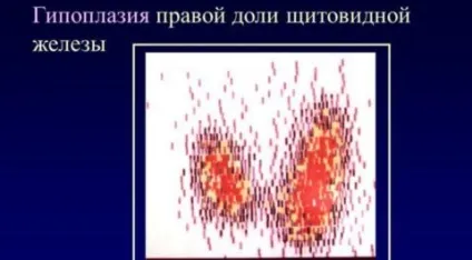 Яка норма обсягу щитовидної залози у жінок, чим небезпечна її гіпоплазія (залози) Яка норма обсягу щитовидної залози у жінок, чим небезпечна її гіпоплазія