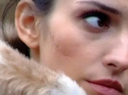 Як освітлити шрам види рубців способи їх лікування і відбілювання (освітлити) Як освітлити шрам види рубців способи їх лікування і відбілювання