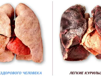 Який прогноз життя дають при емфіземи легенів, симптоми хвороби і методи лікування (життя) Який прогноз життя дають при емфіземи легенів, симптоми хвороби і методи лікування