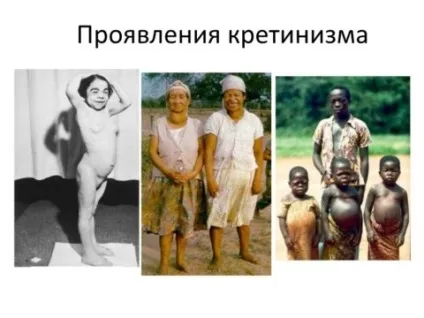 Яка норма обсягу щитовидної залози у жінок, чим небезпечна її гіпоплазія (обсягу) Яка норма обсягу щитовидної залози у жінок, чим небезпечна її гіпоплазія