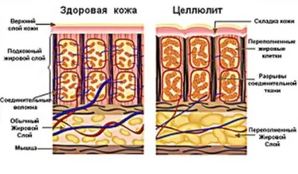 Як запобігти появі целюліту 1 (Малорухливий спосіб життя) Як запобігти появі целюліту 1